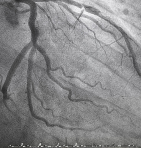 angiogram